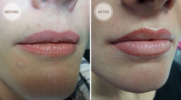 Lip Liner Permanent Makeup